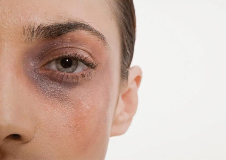 A close up of a bruised left eye